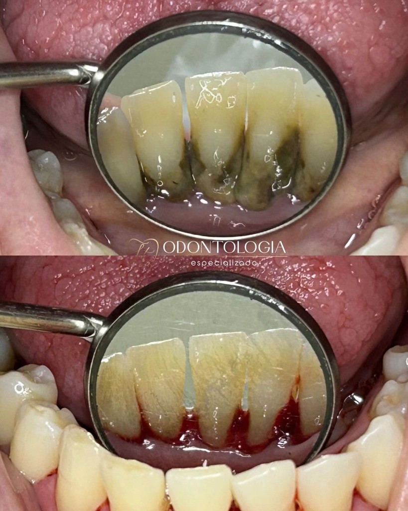 Antes e Depois Limpeza