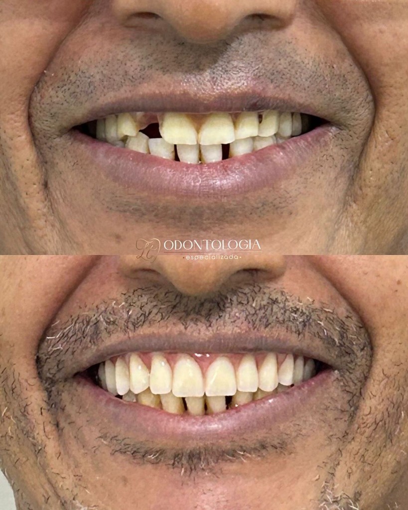 Antes e Depois Implantes