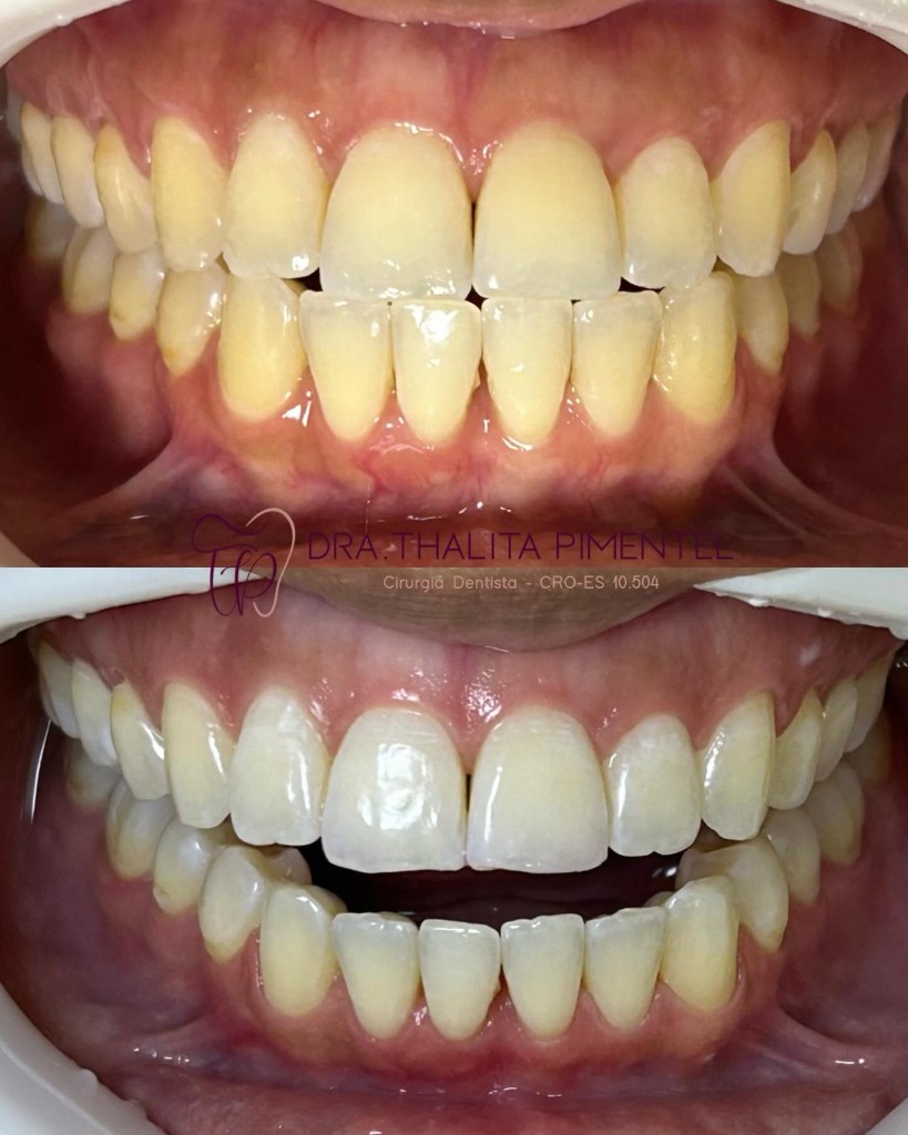 Antes e Depois Clareamento
